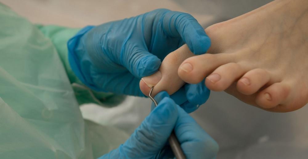 Nail Surgery