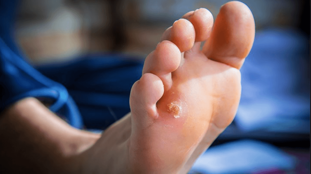 Plantar Wart Management