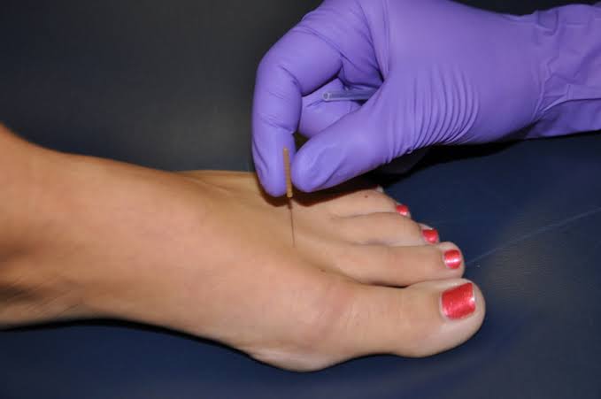 Dry Needling