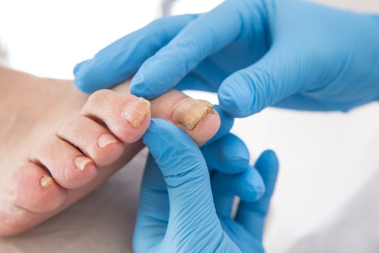 Nail Fungus