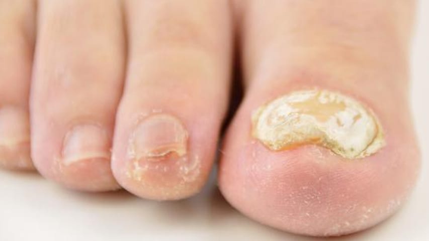 Thickened Toenails