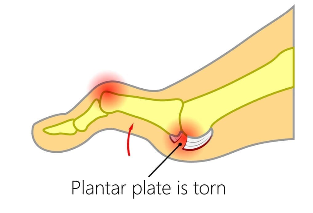 How do I know when a plantar plate is torn