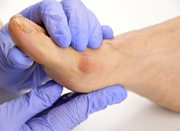 Treatment for bunions