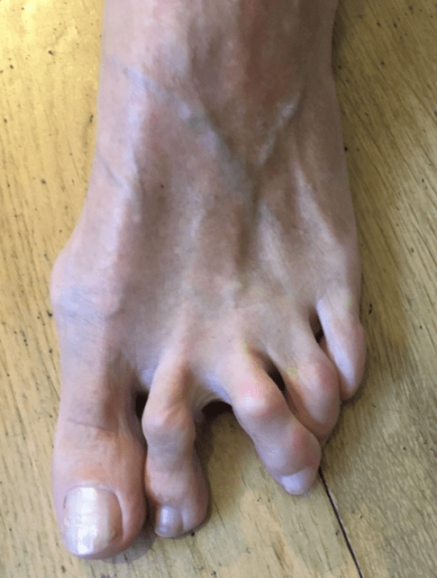 What is a torn plantar plate