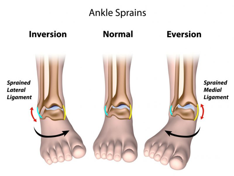ankle ligament strains