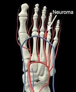 What is Mortons Neuroma What is Mortons Neuroma