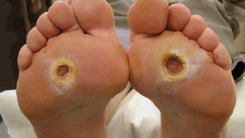Foot Ulcers