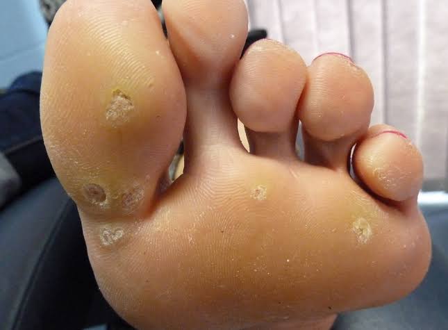 Warts